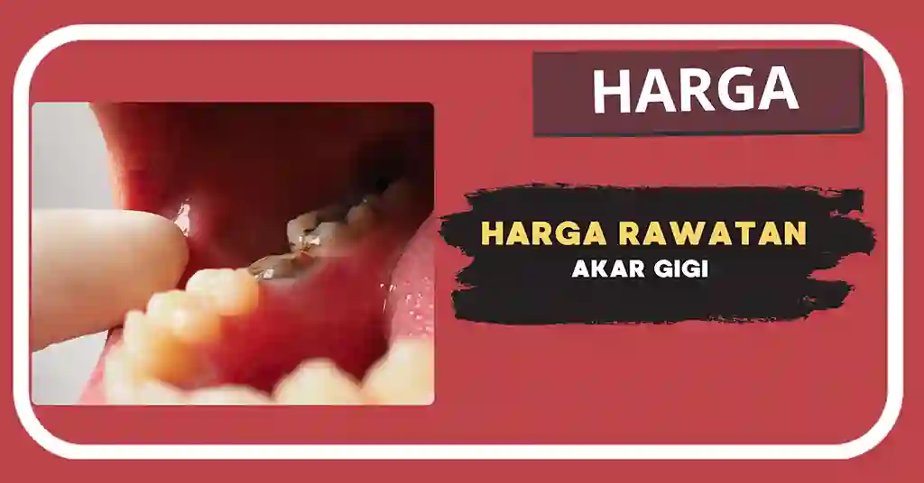 Harga Rawatan Akar Gigi Terkini