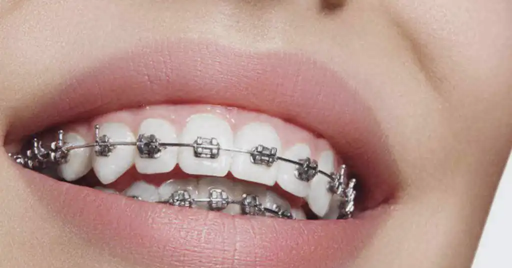 1. Braces Logam Tradisional