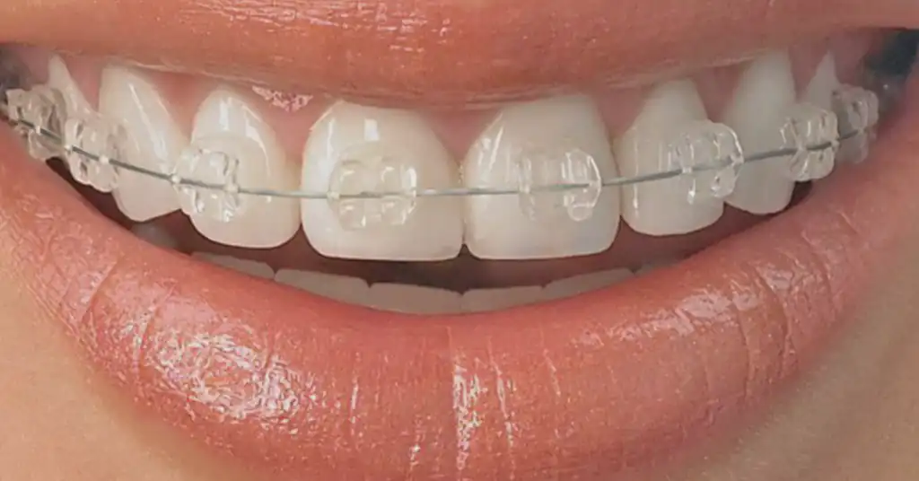 2. Braces Seramik