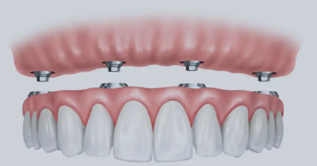 4. Implant-Supported Bridge