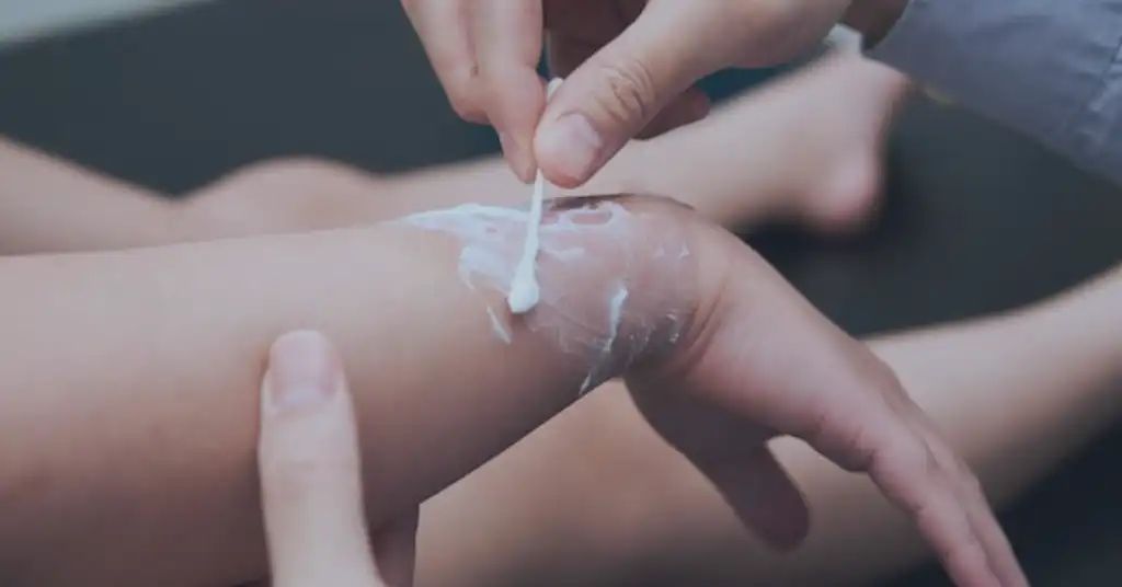 Cara Penggunaan Krim untuk Kulit Melecur