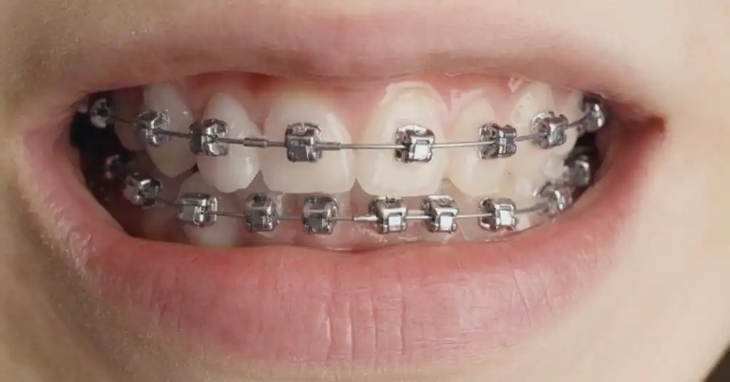 Harga Braces Klinik Kerajaan Malaysia Terkini