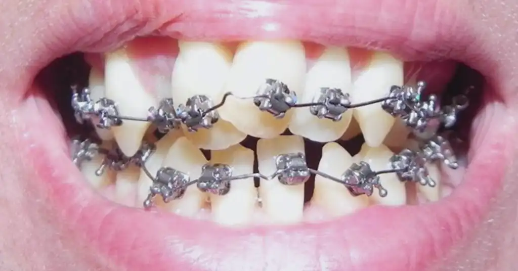 Jenis Braces yang Ditawarkan di Klinik Kerajaan