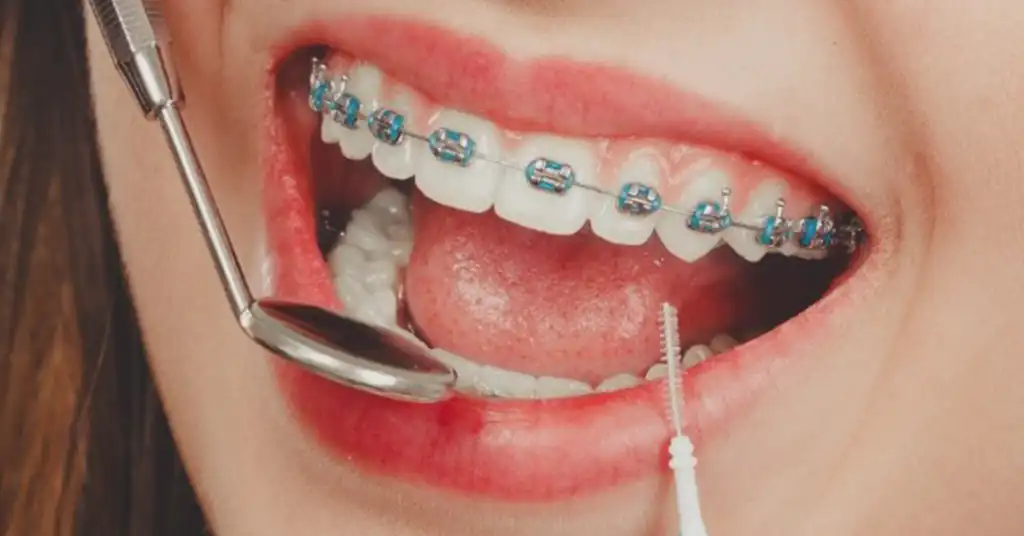 Prosedur Mendapatkan Braces di Klinik Kerajaan