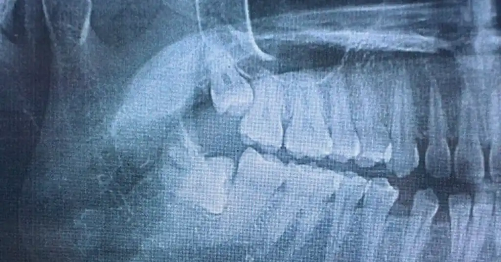X-ray Pergigian