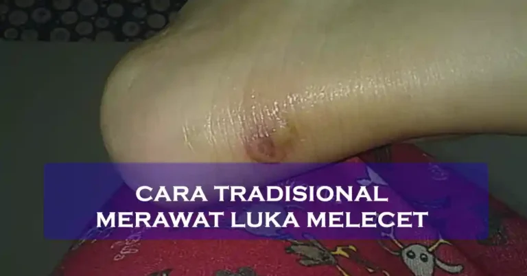Cara Tradisional Merawat Luka Melecet