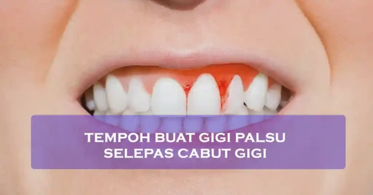 Tempoh Buat Gigi Palsu Selepas Cabut Gigi